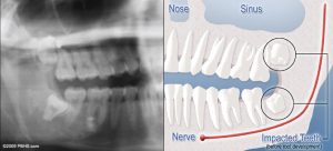 wisdom-teeth